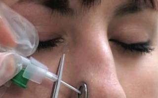 Пирсинг крыла носа: особенности процедуры и виды украшений